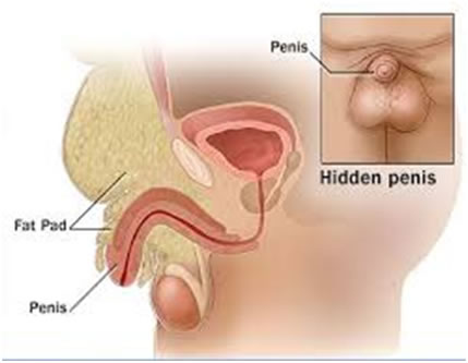 Figure 1. Hidden Penis